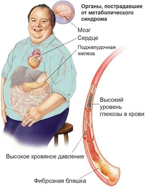 Ожирение и метаболический синдром