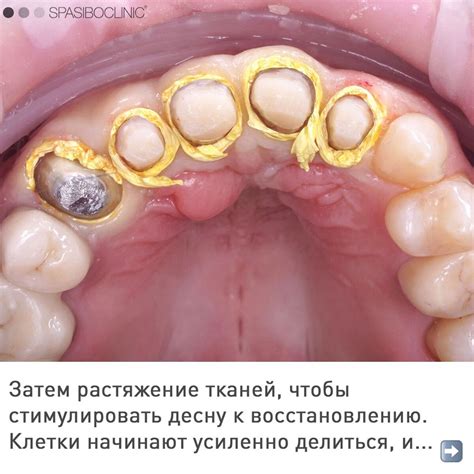 Ознакомление с последствиями и осложнениями после кюретажа зуба