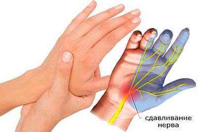 Онемение пальцев при повреждении периферической нервной системы