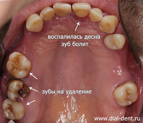 Опасности и проблемы неудаленных корней зубов