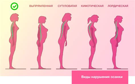 Опасность поперечной осанки у женщин