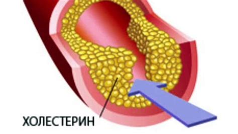 Опасность холестерина: полезные методы повышения уровня!