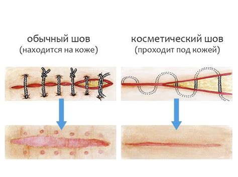 Операции и швы: как ускорить процесс заживления после хирургического вмешательства?