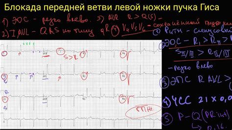 Определение блокады передне-верхней ветви левой ножки пучка Гиса