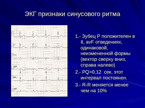 Определение и значение синусового ритма