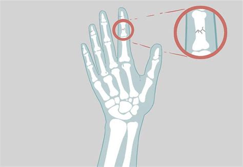 Определение и причины неправильно сросшегося перелома пальца