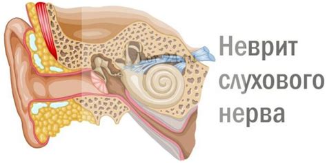 Определение и суть неврита слухового нерва