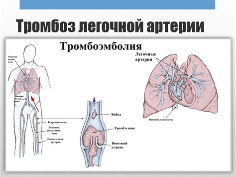 Определение и характеристика эмболии легочной артерии