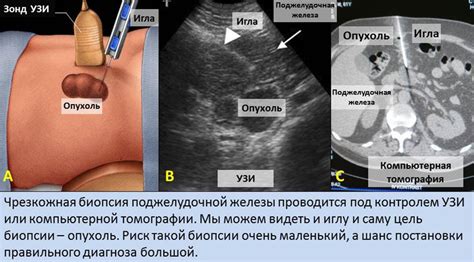 Определение мелковолнистых контуров поджелудочной железы