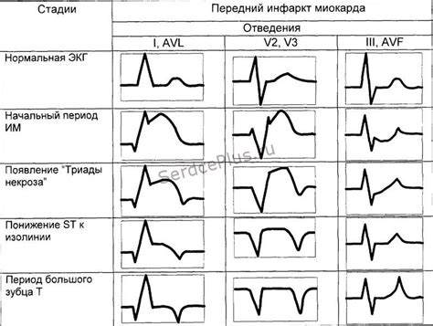 Определение отрицательной динамики на ЭКГ