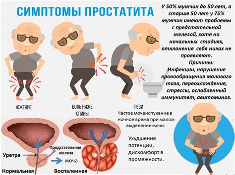 Определение хронического простатита у мужчин