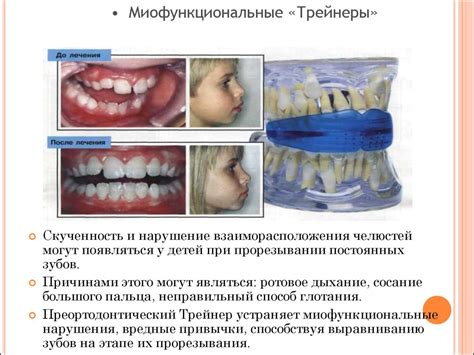 Оптимальные подходы к лечению щелкания зубами