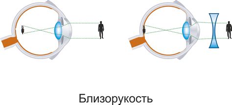 Оптические аномалии и близорукость