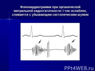 Оптонистагм ослаблен