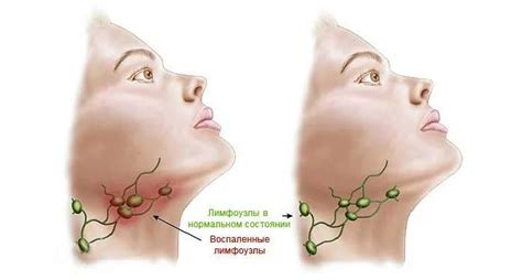 Опухание лимфоузлов: причины и симптомы