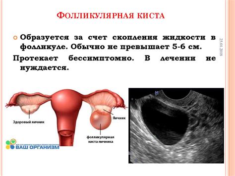 Опухоли и кисты