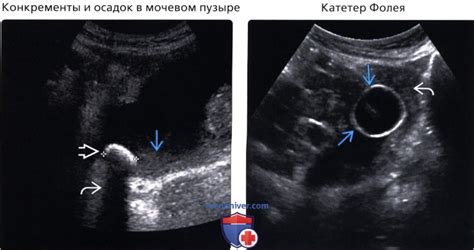 Осадок мочевого пузыря: что это значит?