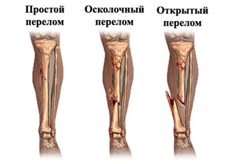 Ослабление костей и повышенный риск переломов