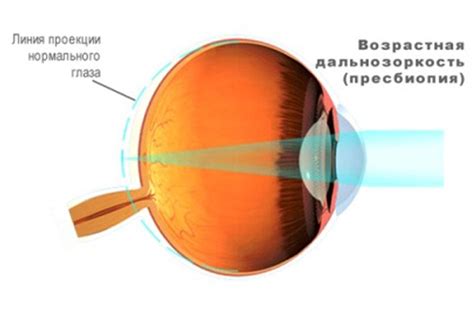 Ослабление сближения глаз