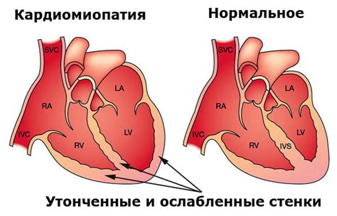 Ослабление сердечной мышцы