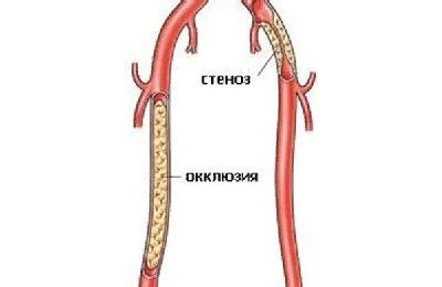 Осложнения и последствия окклюзии сосудов