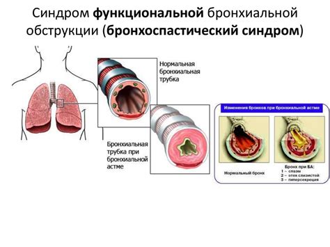 Осложнения необратимой бронхиальной обструкции