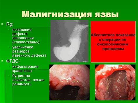 Осложнения эпителиальной неоплазии желудка