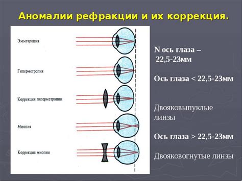 Основные виды нарушений рефракции