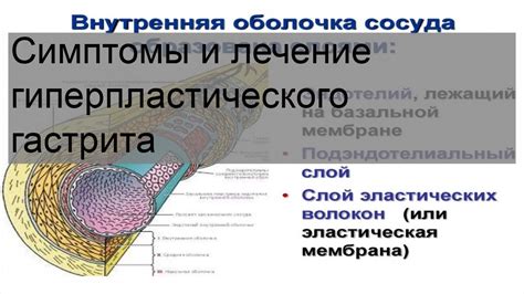 Основные признаки и симптомы полипа гиперпластического тип