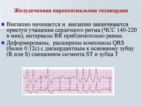 Основные признаки пограничного состояния на ЭКГ