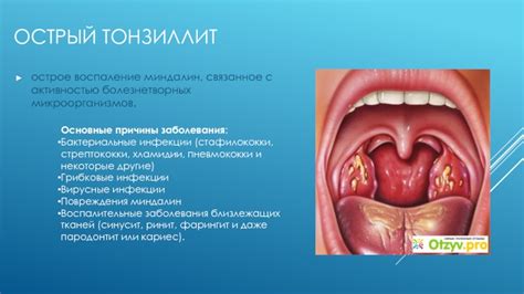 Основные причины гипокомпенсации миндалин 2 степени