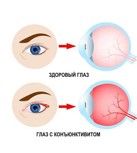 Основные причины жжения в глазах