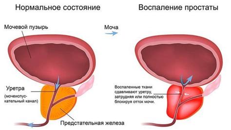 Основные причины подтекания мочи у женщин