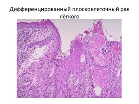 Основные причины развития плоскоклеточного рака с распадом