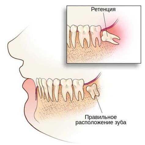 Основные причины ретенции зуба