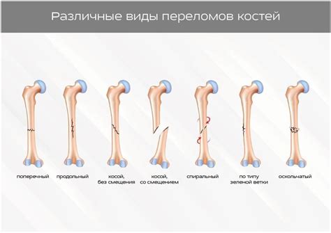 Основные симптомы клинического перелома