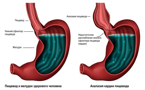 Основные симптомы недостаточности кардии пищевода