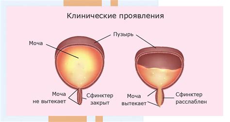 Основные симптомы нейрогенного мочевого пузыря