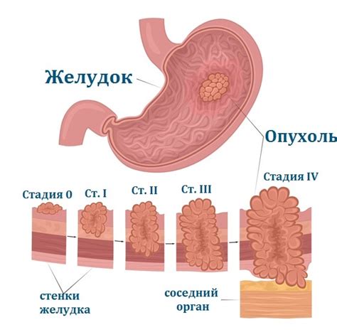 Основные симптомы нейроэндокринной опухоли желудка