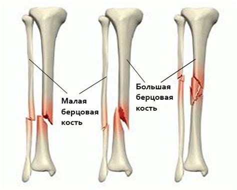 Основные симптомы перелома берцовой кости