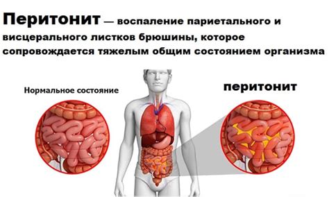 Основные симптомы перитонита