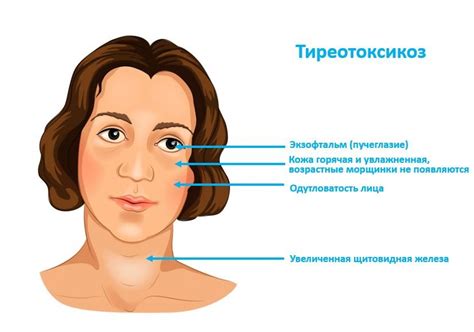 Основные симптомы тиреотоксикоза у мужчин