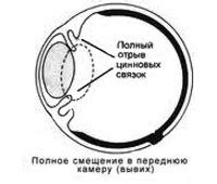 Основные симптомы уплотнения хрусталика глаза