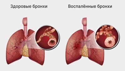 Основные способы лечения отхаркивания крови по утрам