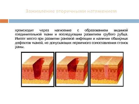 Особенности заживления первичным натяжением швов