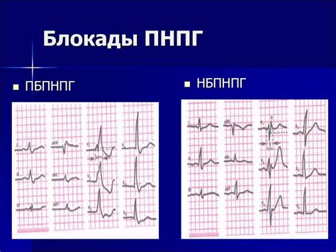 Особенности неполной блокады правой ножки у детей