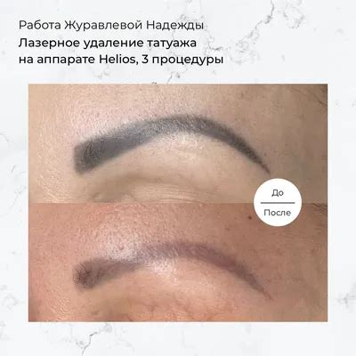 Особенности удаления на разных частях тела