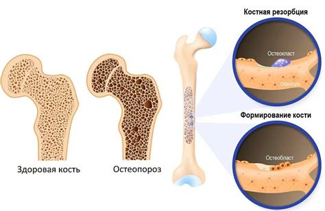 Остеопороз и ослабление костной ткани