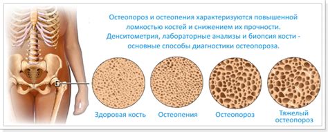 Остеопороз и полые кости