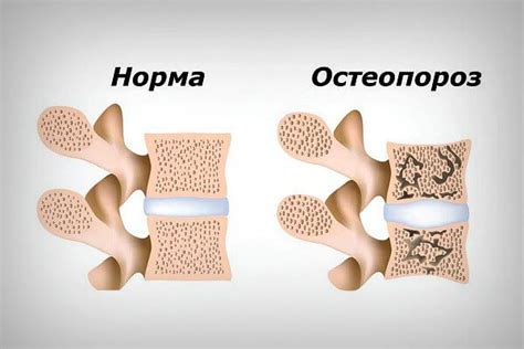 Остеопороз стоп: причины и симптомы